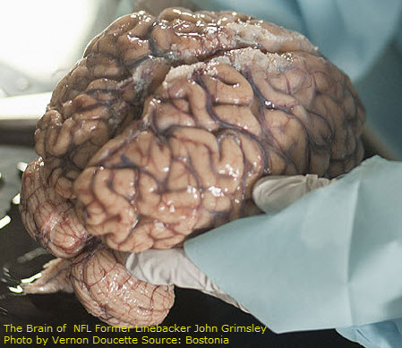 NFL-Brain-Injury.jpg