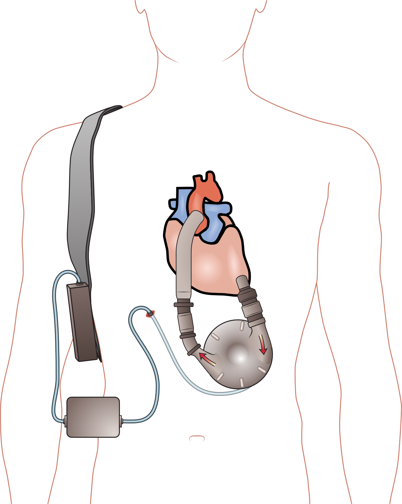 Ventricular_assist_device.png