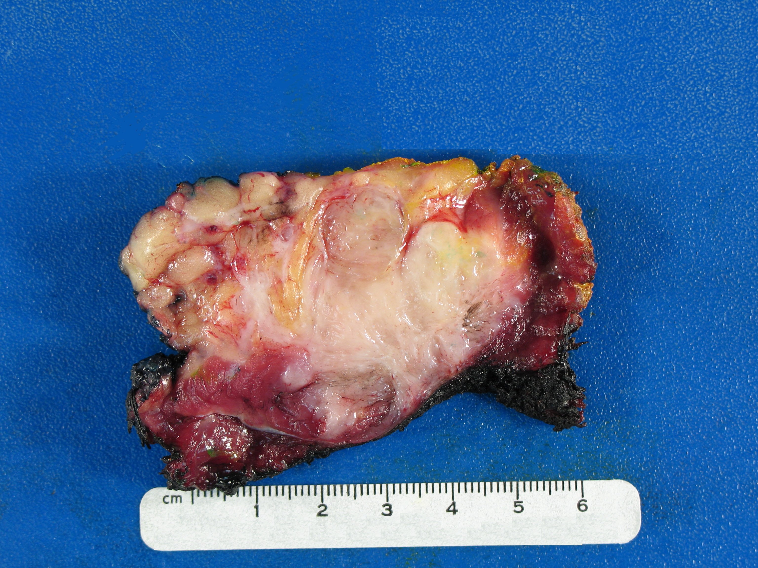 Desmoid-type_fibromatosis.gross_pathology