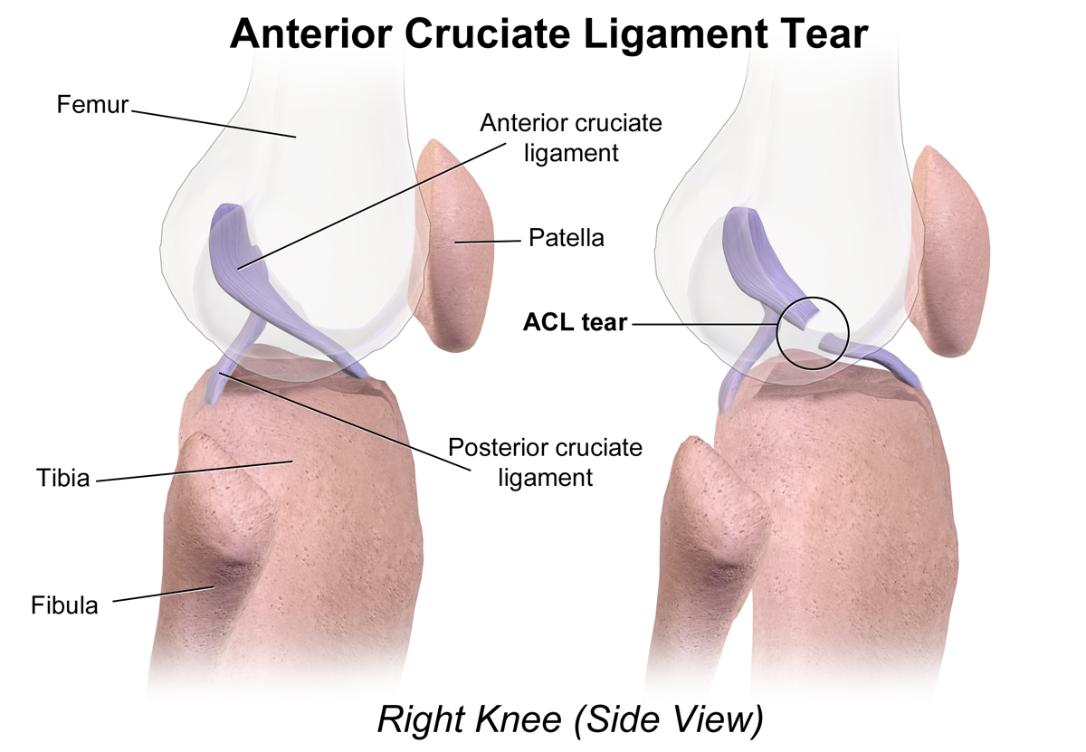 ACL Injury