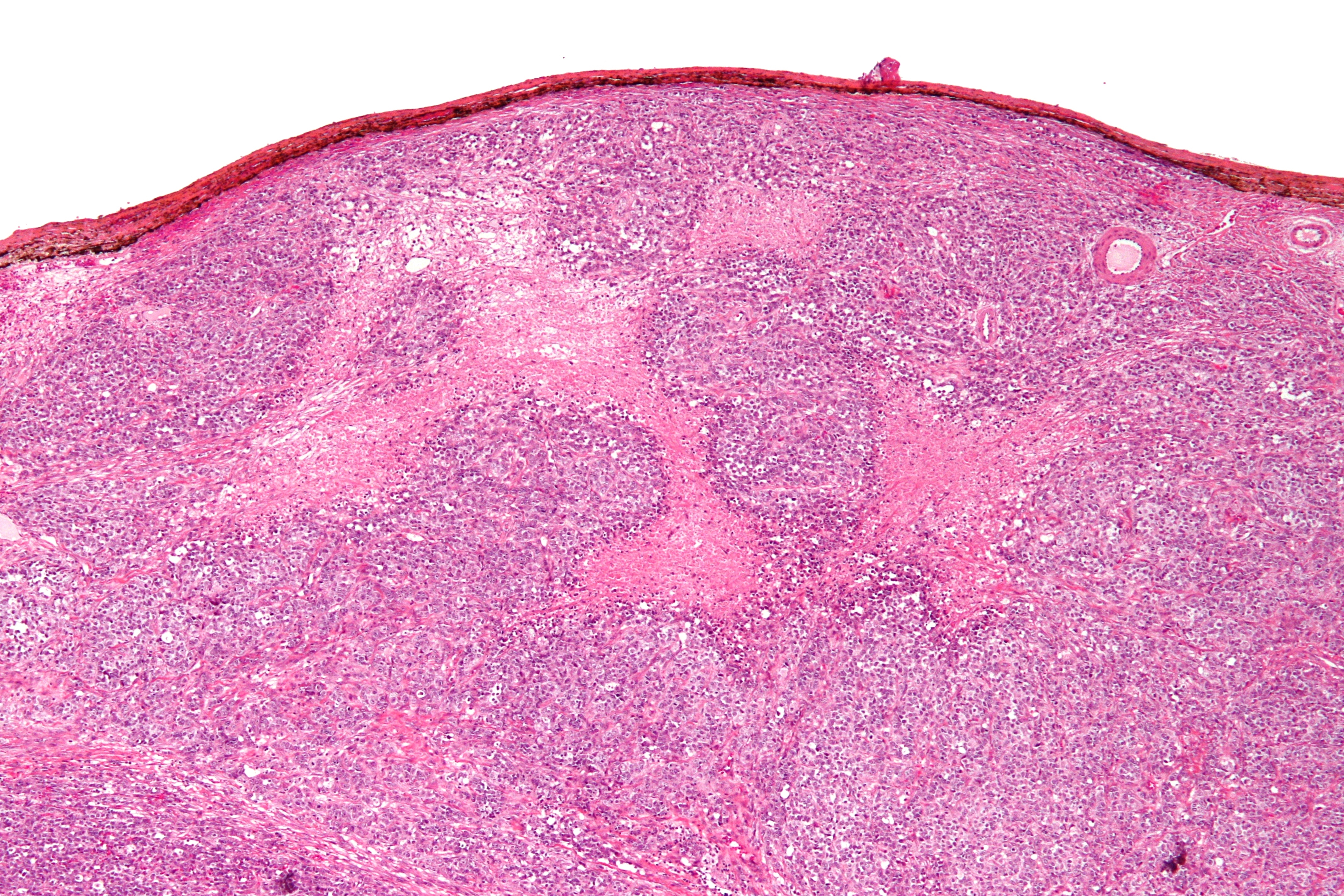 Small_cell_carcinoma_of_the_ovary_hypercalcemic_type_-_low_mag