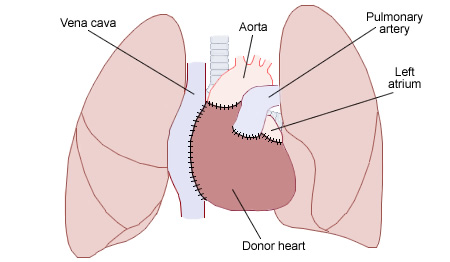 Heart_transplant-wikipedia
