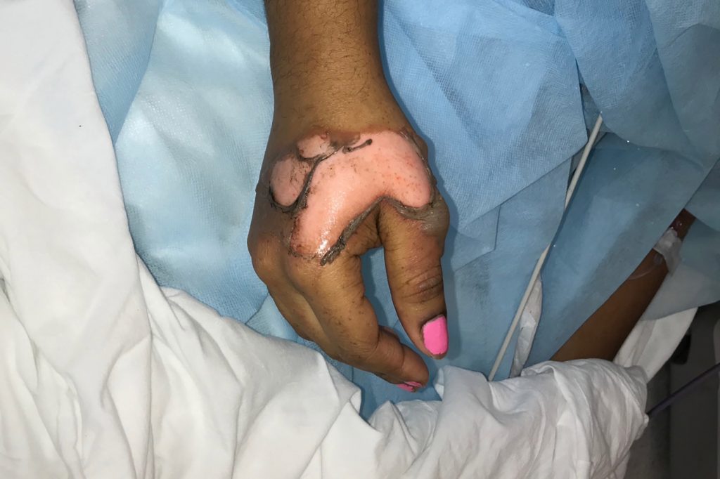 Another high school student severely burned in chemistry